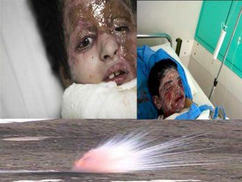Afghan+child+hit+by+White+Phosphorous+bombs+fired+by+American+Terrorists.jpg