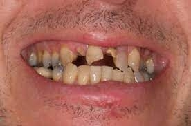 broken teeth.webp