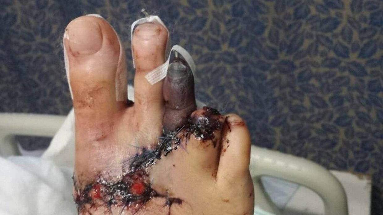 Damaged toes 1.jpg