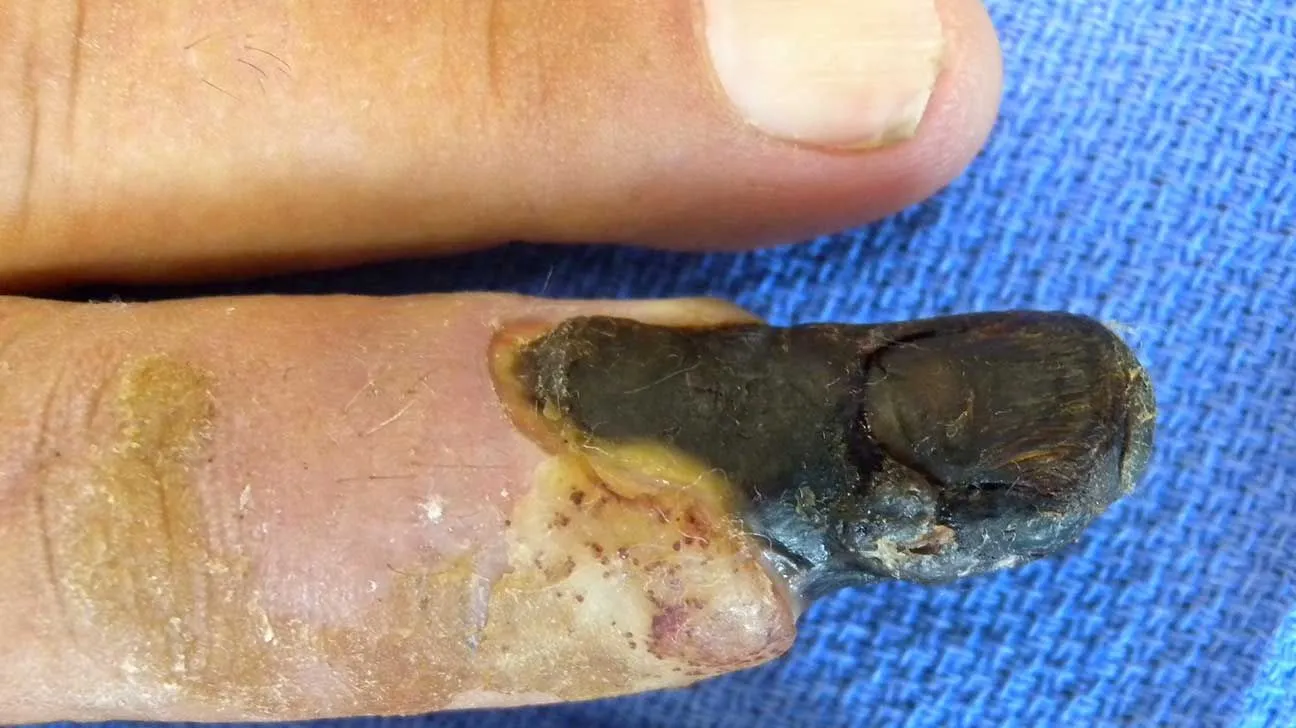 Dry-Gangrene.webp