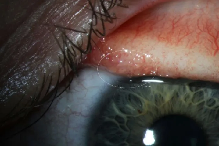 eye-worm-180212.webp