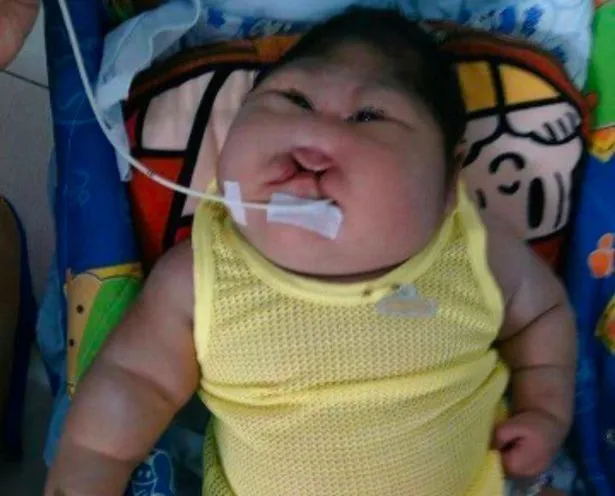 PAY-HEARTBREAKING-pictures-show-deformed-baby-that-needs-help.webp