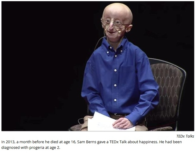 Progeria .webp