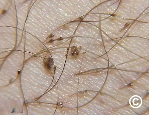 Pubic_lice_2_fee391183f15cb4d62773032fe0be92d.jpg