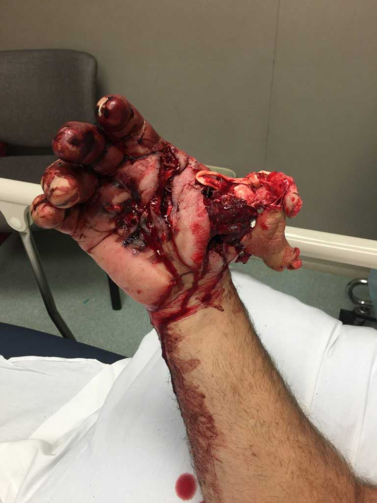 rifle-kaboom hunting-accident1.webp