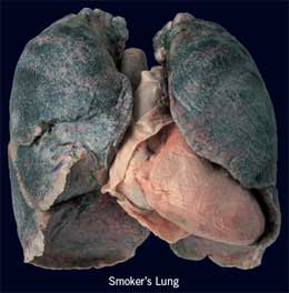 smokers-lung-picture-2.jpg