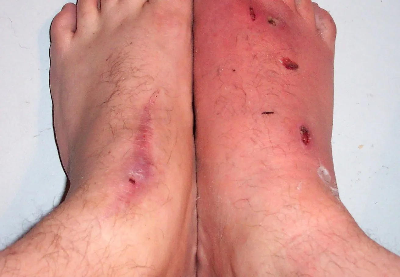 swollen foot_1.webp