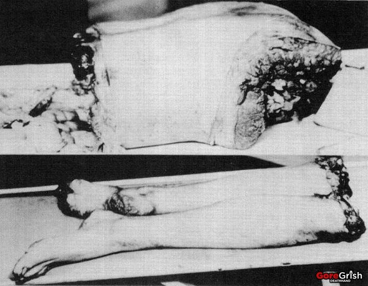 torso-murders7-vic7-torso-legs-Cleveland-OH-1934-38.jpg