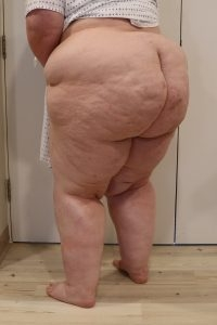 Type-I-Stage-3-lipoedema.webp