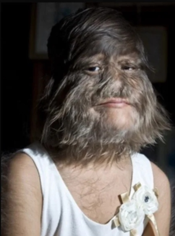 Werewolf syndrome .webp