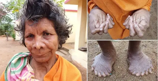 woman with 31 fingers and toes 1.webp
