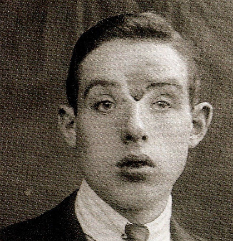 World War I Great One WWI wounded British soldier face wound.jpg