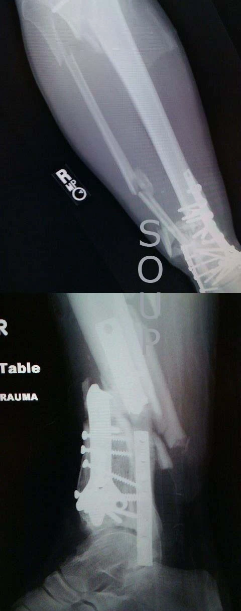 yatesx-ray.webp