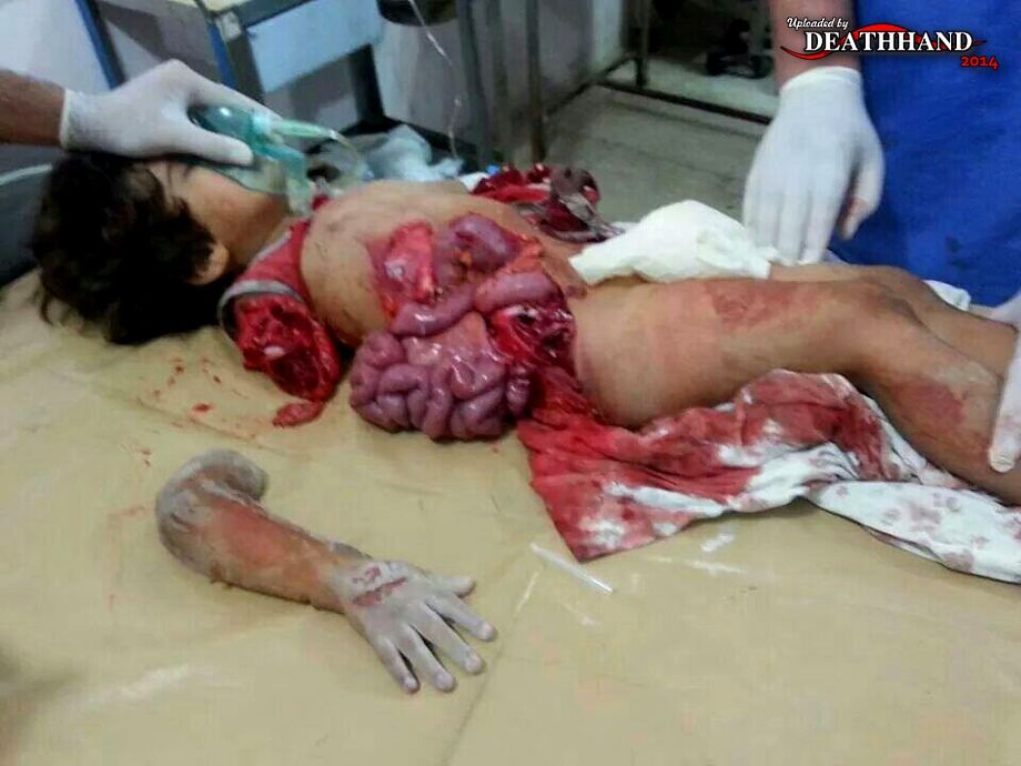 young-girl-seriously-injured-in-bombing-survives-1-Aleppo-SY-jun-6-14.jpg