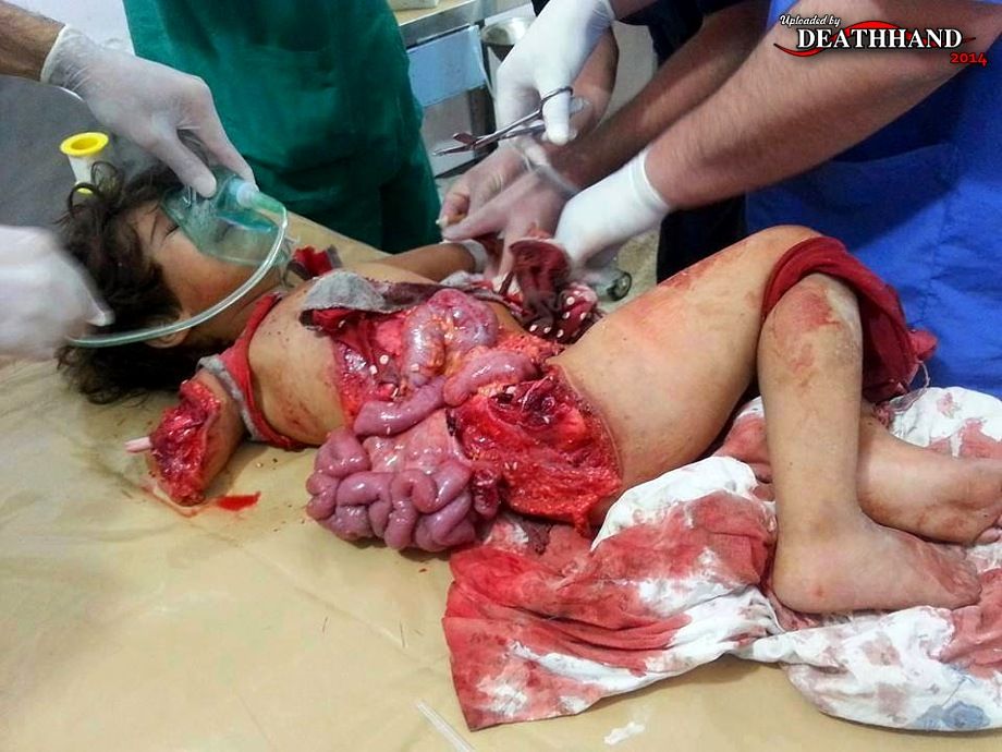 young-girl-seriously-injured-in-bombing-survives-2-Aleppo-SY-jun-6-14.jpg