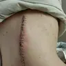 Digiteliminator