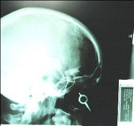 xray-shows-cuff-key.jpg
